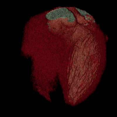 Um coração humano com uma angioplastia com stent