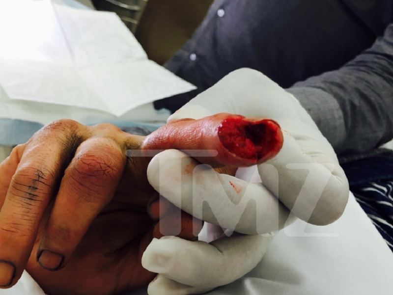 Johnny Depp machucou dedo em surto
