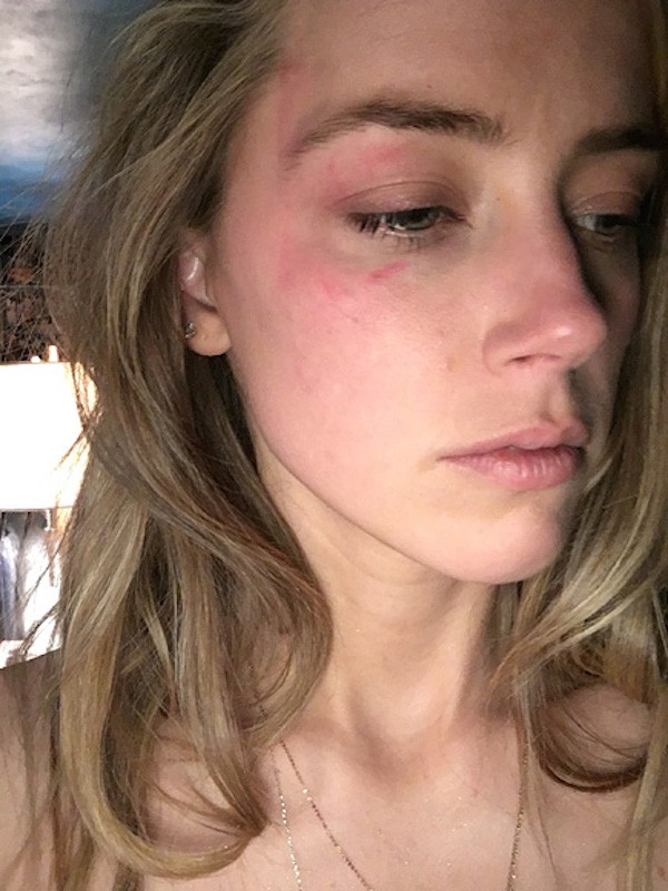 Amber Heard alega ter sido agredida por Depp