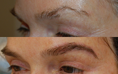 Antes e depois do transplante de sobrancelhas