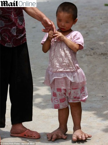 Com pés gigantes, menina chinesa busca ajuda para tratamento de anomalia