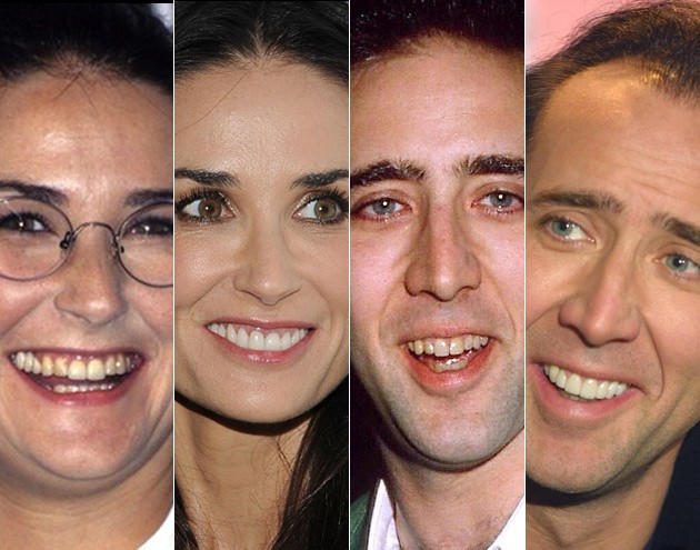 Antes e depois dos dentes dos famosos 