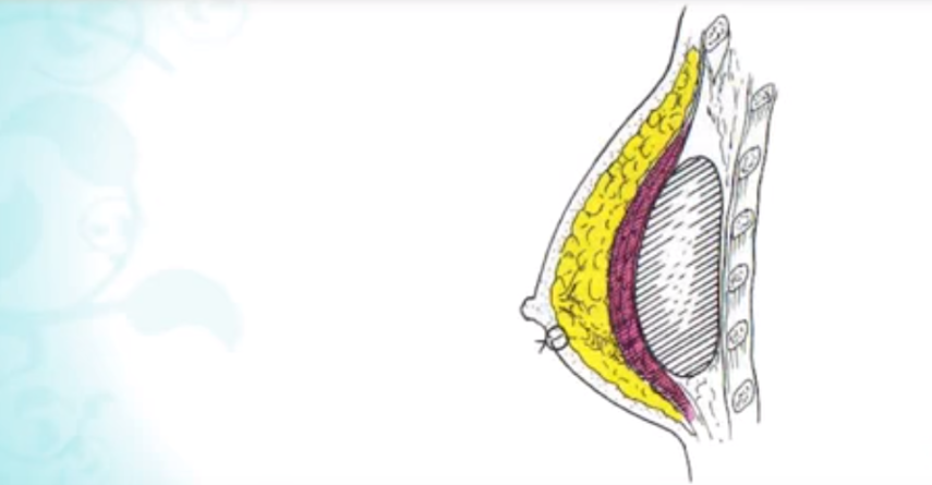 Na sala de cirurgia: a prótese pode ser colocada abaixo da glândula ou abaixo do músculo