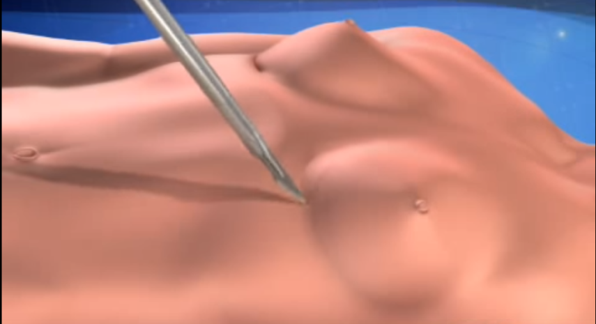 Na sala de cirurgia: são três opções de locais para o corte por onde a prótese é inserida, que varia de acordo com o biotipo do paciente: na área da axila, de cerca de quatro centímetros, ao redor da aréola, ou abaixo da mama