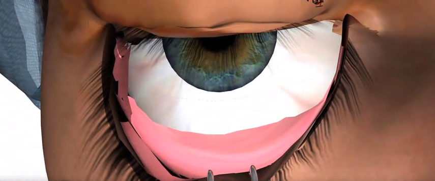 Na sala de cirurgia: o procedimento pode ser feito na parte superior aos olhos e inferior