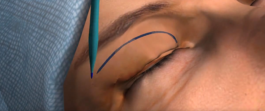 Na sala de cirurgia: o corte pode ser feito por dentro da conjuntiva dos olhos, quando não fica cicatriz aparente, ou rente aos cílios, tudo depende das necessidades do paciente, segundo explicou o cirurgião Rodrigo Rosique