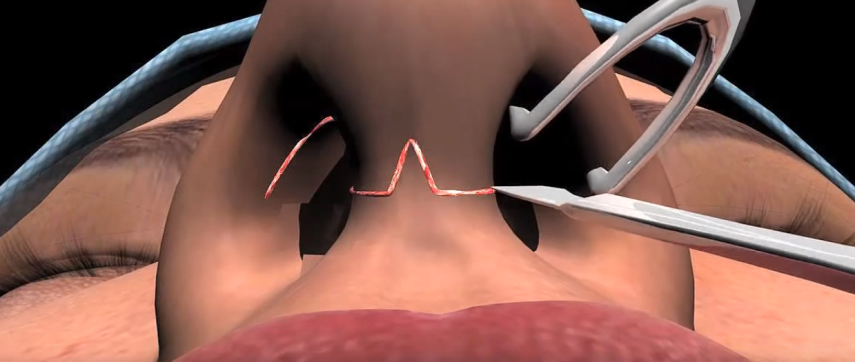 Na sala de cirurgia: : a rinoplastia aberta é comum entre os cirurgiões. Trata-se de faze rum corte na parte inferior do nariz e levantar a pele para ter visibilidade melhor da área