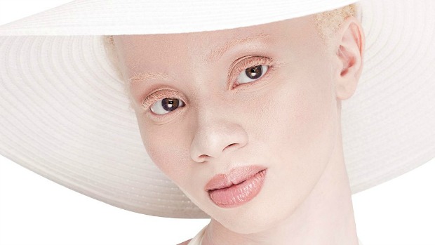 A sul-africana Thando Hopa, que é albina, superou suas limitações e hoje é uma referência para crianças que vivem com albinismo em sua terra natal. Ao se tornar modelo, inspirou muitas mulheres com sua história