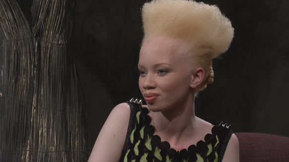 A sul-africana Thando Hopa, que é albina, superou suas limitações e hoje é uma referência para crianças que vivem com albinismo em sua terra natal. Ao se tornar modelo, inspirou muitas mulheres com sua história