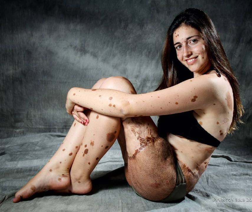 Alba Parejo, de Barcelona, tem mais de 500 manchas e marcas espalhadas pelo corpo. Apesar do sofrimento e do passado de bullying, ela insiste e persiste na carreira de modelo. Apenas maravilhosa!