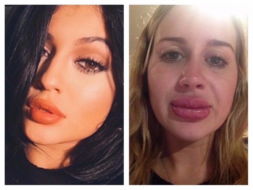  Brittany teve problemas com suas intervenções e acabou ficando com lábios muito grandes ao tentar se parecer com Kylie Jenner