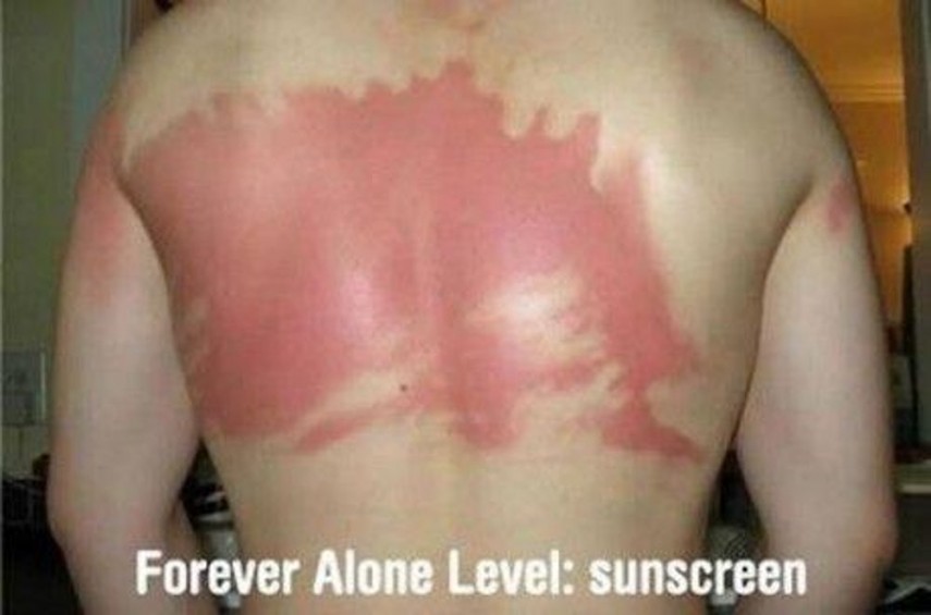 Piores queimaduras de sol