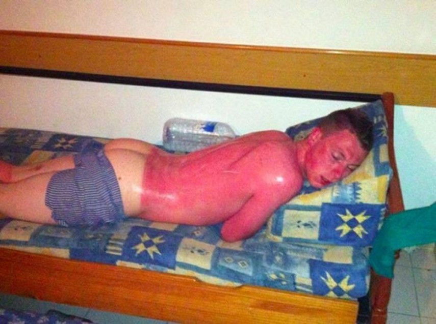 Piores queimaduras de sol