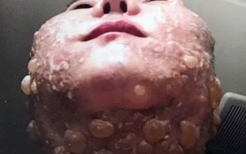 Mulher fica com rosto coberto por bolhas após tratamento estético mal feito