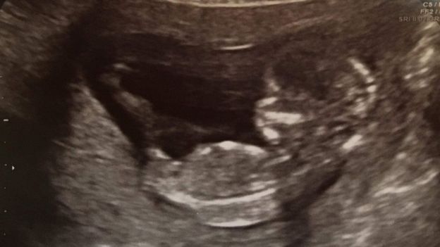 O ultrassom confirmando a gravidez para o casal