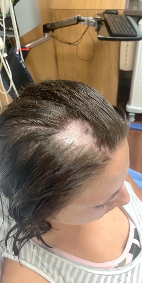 Os cabelos de Ashley Rose começaram a cair e a jovem foi obrigada a raspá-los após utilizar um condicionador supostamente adulterado dentro do mercado. Ela acredita que alguém tenha acrescentado creme depilatório no produto