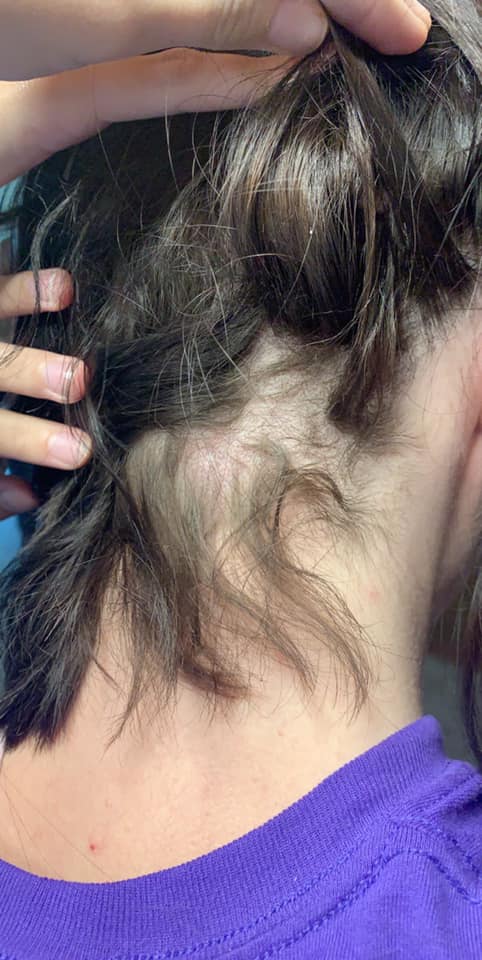 Os cabelos de Ashley Rose começaram a cair e a jovem foi obrigada a raspá-los após utilizar um condicionador supostamente adulterado dentro do mercado. Ela acredita que alguém tenha acrescentado creme depilatório no produto