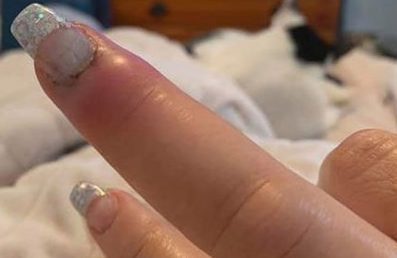 Mulher registra evolução de infecção no dedo