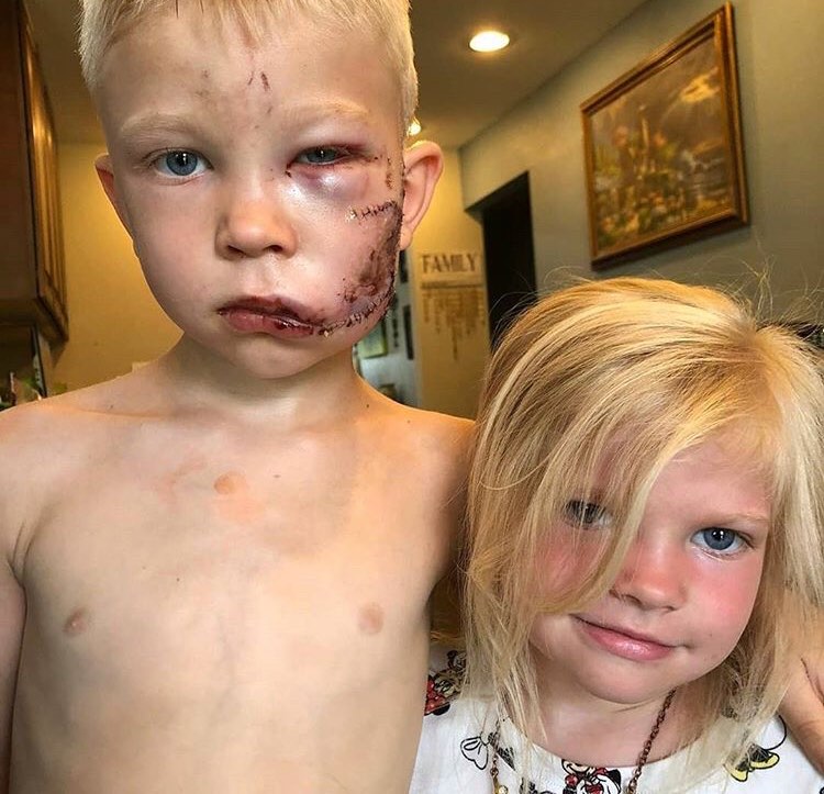 Menino de seis anos salva irmã de ser atacada por cachorro